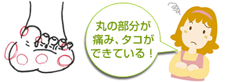 丸の部分が痛み、タコができている！