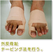 外反母趾テーピング法を行い、足指を正しい形に戻し、本来の足指の機能を戻します。